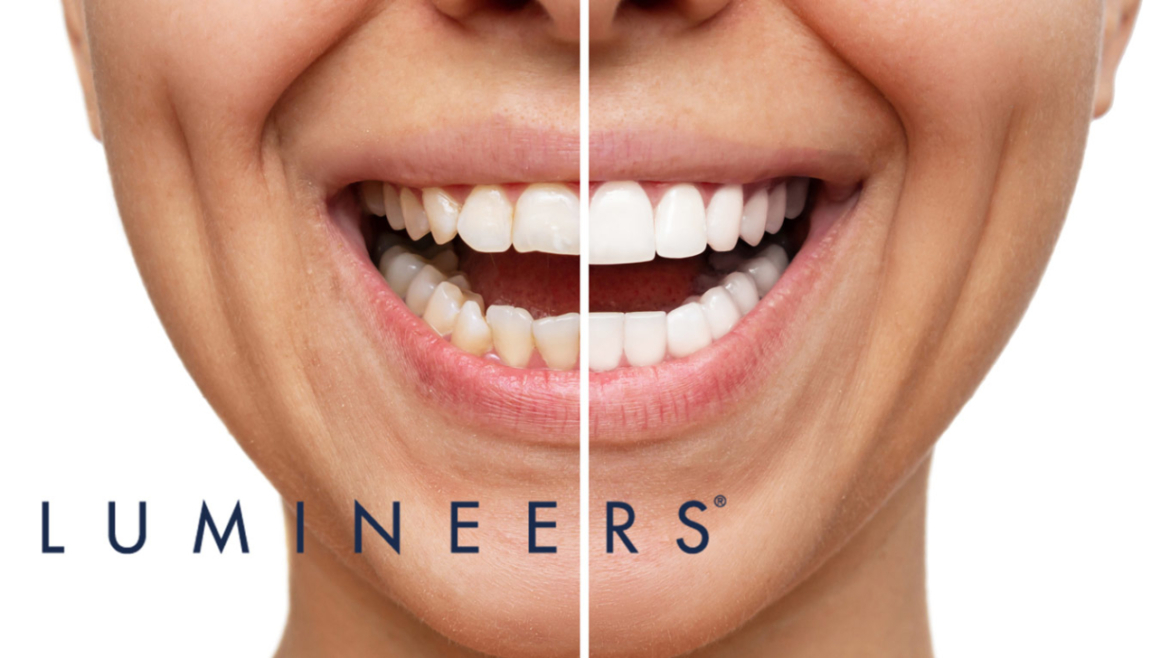 Faccette dentali Lumineers® a Sorrento: la soluzione indolore e rapida per un sorriso perfetto