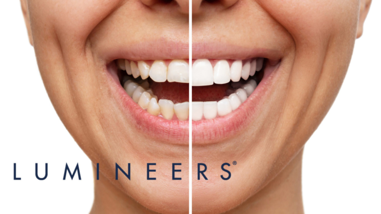 Faccette dentali Lumineers® a Sorrento: la soluzione indolore e rapida per un sorriso perfetto